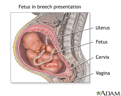 baby in breech position in womb