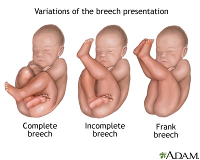 Variations of the breech position. 
