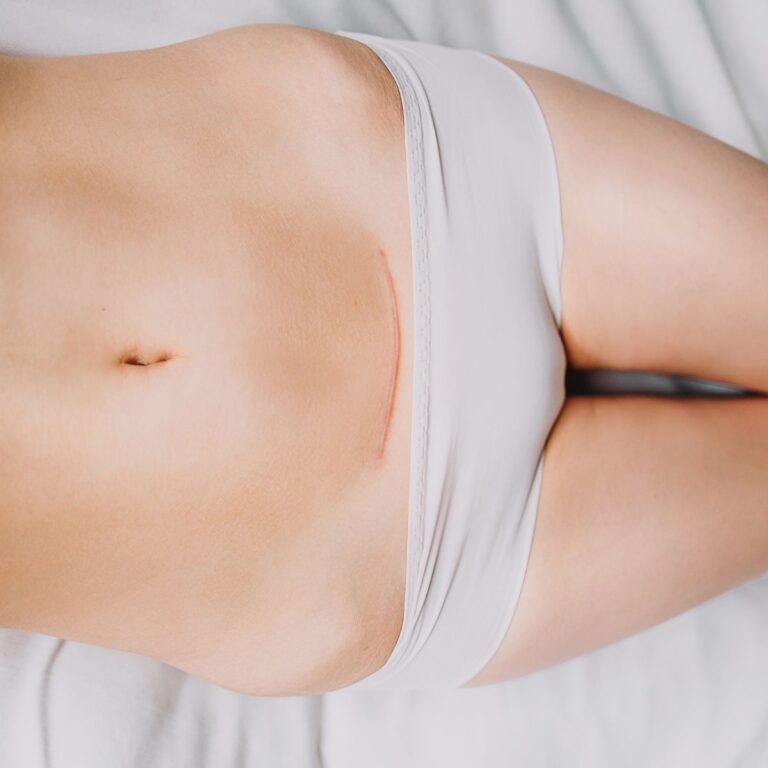Scar Tissue from C-Section Causing Abdominal Pain Years Later? Here’s How to Help