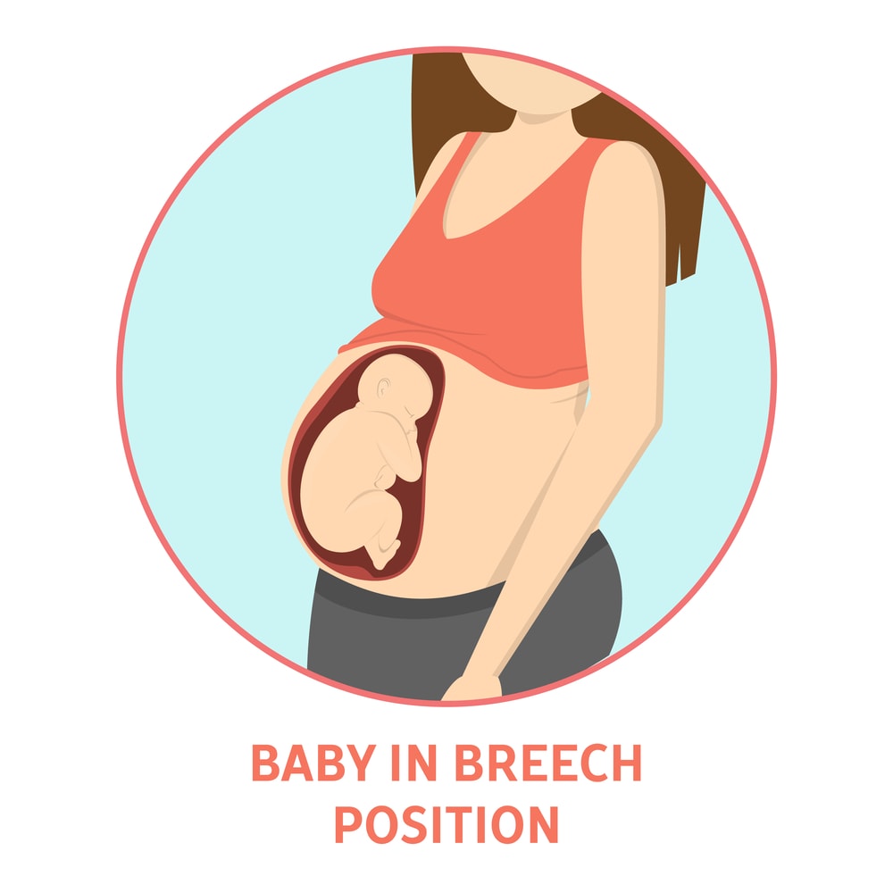 signs of a breech baby